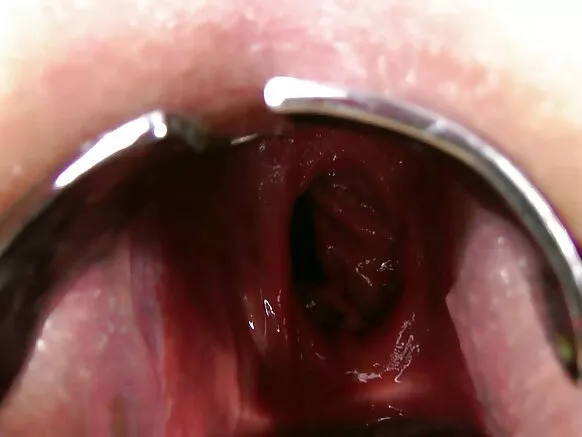 Dachaa qaama saalaa fisting, prolapse, badhaadhaa manaa daawwitii gaping.